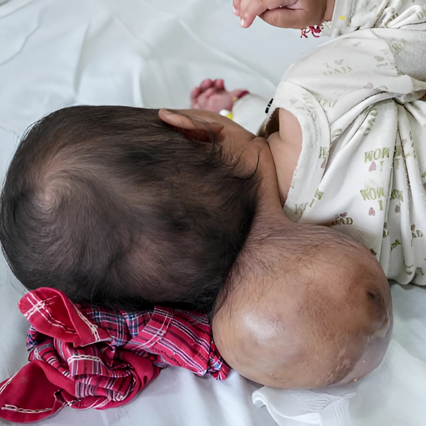 10-Month-Old Devanshi’s Neck Tumour Is Stealing Her Childhood