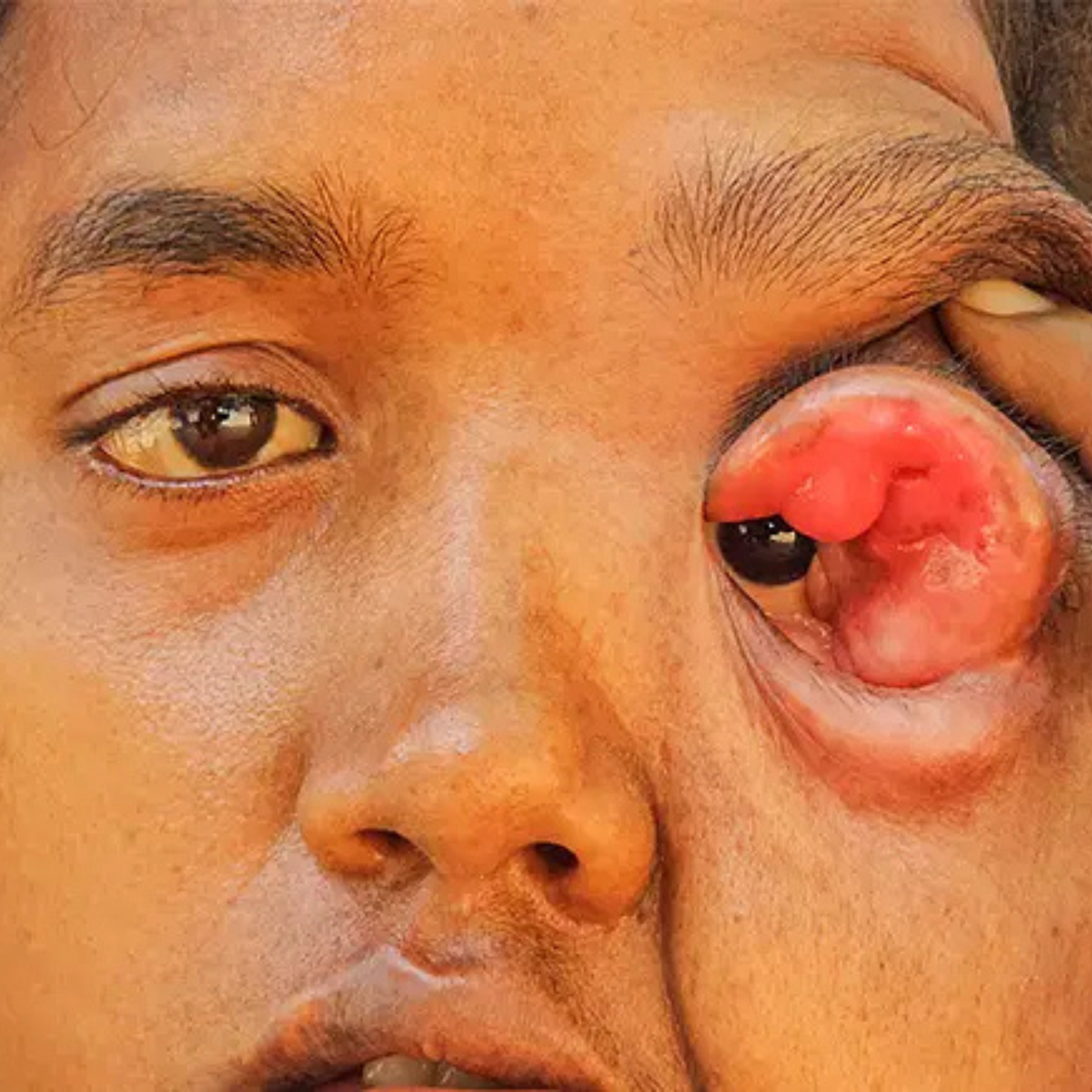 Single-Mother Can't Afford Surgery for Tumour that's Blinding Daughter